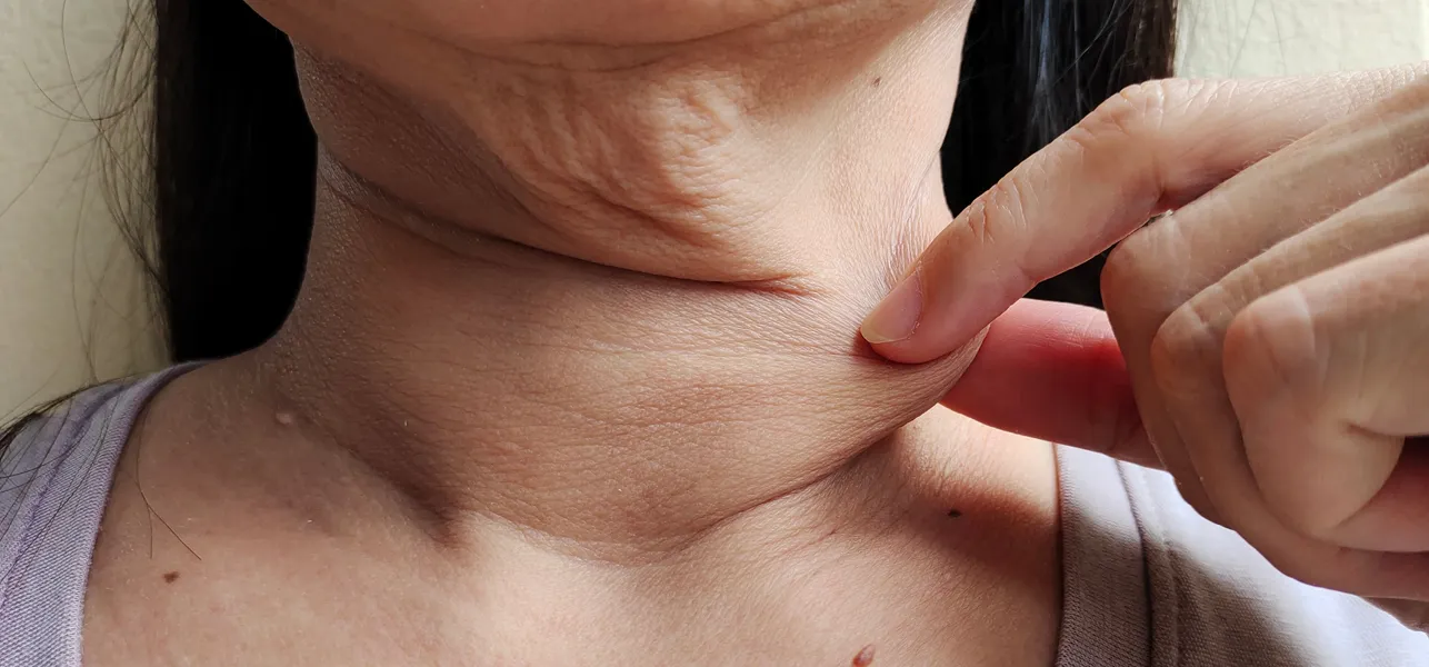 will losing weight help turkey neck